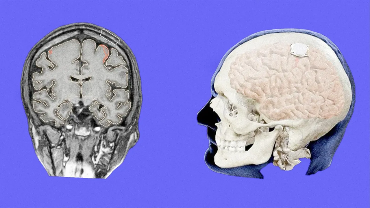 В Neuralink Илона Маска имплантировали чип третьему пациенту